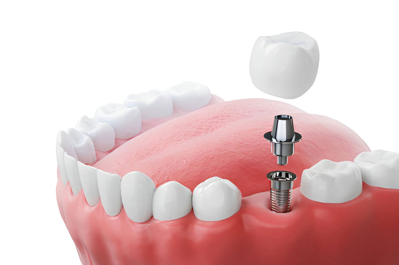 Close-up of a dental restoration procedure, illustrating the repair of a damaged or decayed tooth to restore its function and appearance.