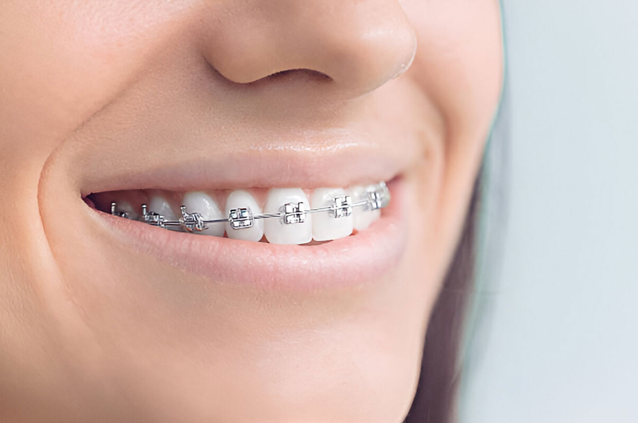 Close-up of a smiling individual wearing metal braces, showcasing orthodontic treatment for teeth alignment.